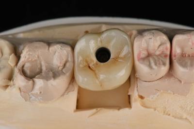 China Implantes dentales de titanio de 10 mm con un solo diente Reemplazo de abutment auto-tapping en venta