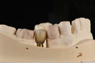 China Sandblasted Single Tooth Implant With Self Tapping Thread And Internal Hex Connection for sale