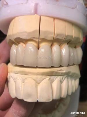 China Precision Fit Porcelain Fused to Metal PFM Crowns Seamless Natural Smile Enhancement for sale