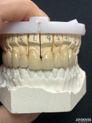 China Seamless PFM Porcelain Fused Metal Crown For Long Term Biocompatible Restoration for sale