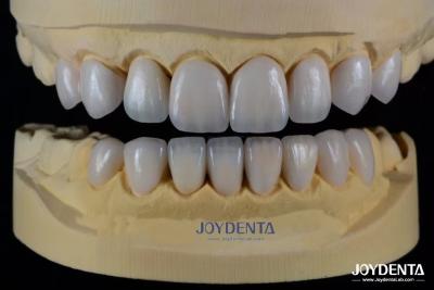 China Advanced Ceramic Porcelain Veneers Biocompatible Shade Matched for a Natural Smile for sale