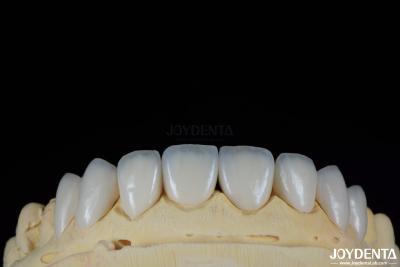 China Carillas dentales duraderas y resistentes a manchas con tonos personalizados para dientes naturales en venta