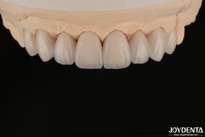 China Carillas dentales suaves y ligeras, biocompatibles y cómodas para la salud oral en venta