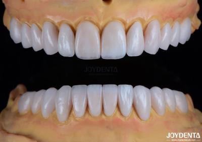 China Resistencia a las manchas y mantenimiento del brillo Las carillas dentales para la garantía de transformación de los dientes astillados en venta