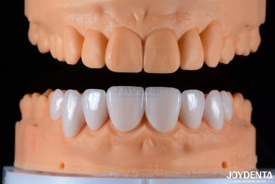 China Secure Fit Porcelain Veneers Ceramic and Natural Aesthetics with Strong Adhesion for sale