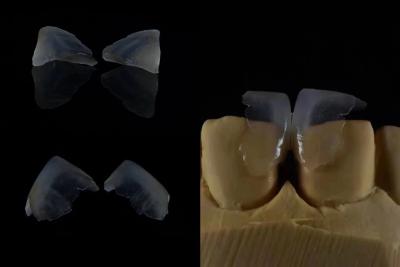 China Carillas dentales cómodas Enlace fuerte con esmalte dental para un ajuste seguro Ligero y suave para una comodidad óptima del paciente en venta