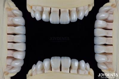 China Cerámica para estética natural carillas dentales Resistencia a manchas mantiene el brillo fuerte unión con el esmalte dental para un ajuste seguro en venta