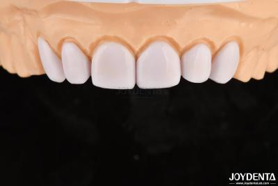 China Carillas dentales para dientes mal alineados Biocompatibilidad y suavidad en los tejidos orales en venta