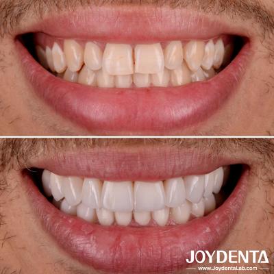 China Perfeito Apto Veneers Dentes de Porcelana Transparência Natural Veneers Dental Laminado à venda