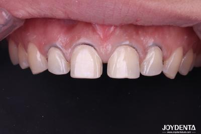 China Veneers de porcelana dentária de aparência real perfeitamente adequado Veneers de cerâmica para dentes da frente à venda