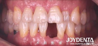 China Customizable Dental Maryland Resin Bonded Bridges for Anterior And Premolar Teeth for sale