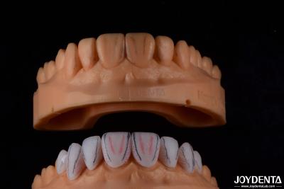 China Maßgeschneiderte Dental Emax Keramik Veneers mit Schmutzfestigkeit zu verkaufen