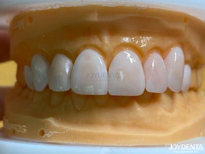 China Hohe Durchlässigkeit Natürliche Veneers Porzellan Veneers Emax kundenspezifisch zu verkaufen