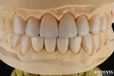 China 0.3-0.5mm Thick Feldspathic Porcelain Veneer High Fracture Resistance Upgrade Your Smile for sale