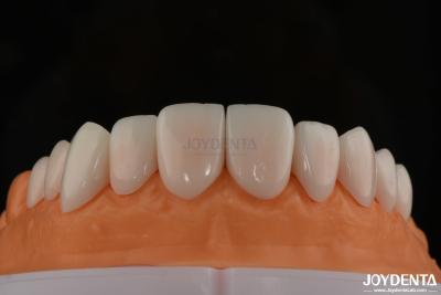 China A1-A4 Ips Emax Prensa de porcelana Folheados dentários resistentes a manchas Forma personalizável à venda