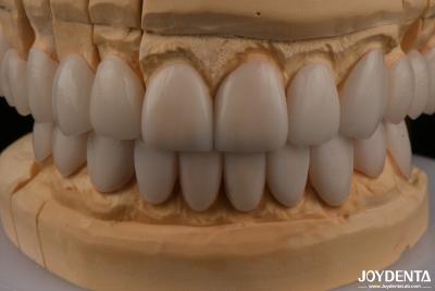 China 0.3 mm Dicke Ips Emax Veneers Keramik Veneers Vorder- und Hinterseiten Restaurierungen zu verkaufen