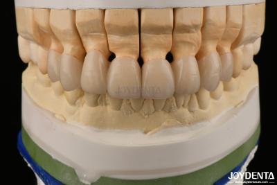 China High Translucency Layered Zirconia Crowns Bridges Dental Restorations lifelike appearance for sale