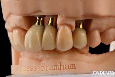 China Precision Dental Implant Crown and Bridge Perfect Solution for Aesthetically Pleasing Smile for sale