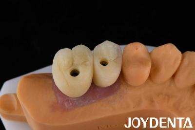 China Porcelain Implant Crown and Bridge The Ultimate Solution for Restoration Of Missing Teeth for sale