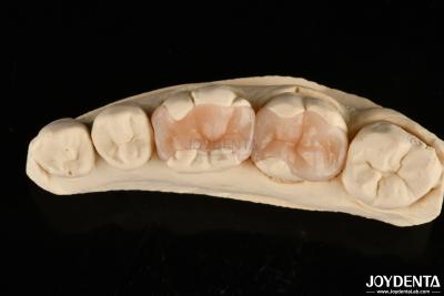 China Natuurlijke gepolymeriseerde porseleinen tandheelkundige inlay Onlay voor tandherstel Te koop