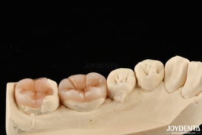 China Natural Looking Composite Inlay Onlay Dental Restoration With Natural Appearance for sale