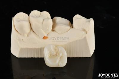 China Zirconia Inlays And Onlays Tailor Made Restorations For Unparalleled Fit And Esthetics for sale