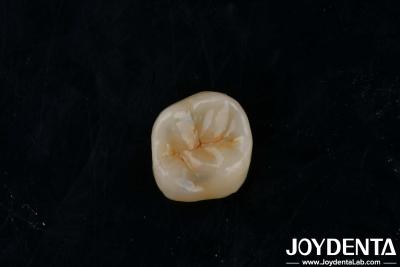 China Customizable Adhesive Zirconia Inlays Onlays High Translucency For Restoration for sale