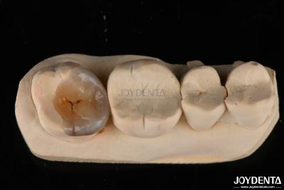 China Custom Natural Looking Emax Dental Inlays And Onlays For Tooth Restoration for sale