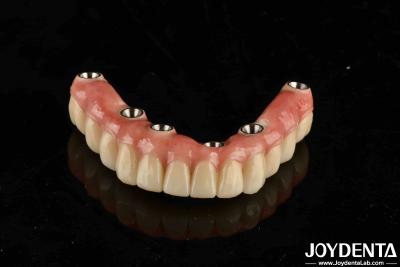 China Ponte de implantes dentários de titânio Malo combinando técnicas tradicionais e modernas à venda