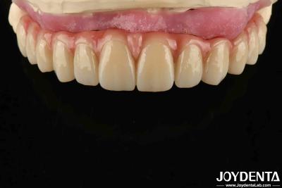 China Confortável Uso Titânio Malong Hybrid Bridge Dental Design ajustável Peso leve à venda