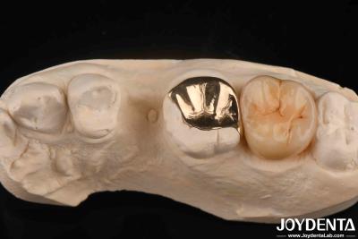 China Coroa dental de ouro resistente ao desgaste com 60K Metal à venda