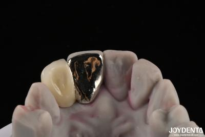 Cina Metallico Dental Maryland Bridge Buona funzione di masticazione per un rimedio duraturo in vendita