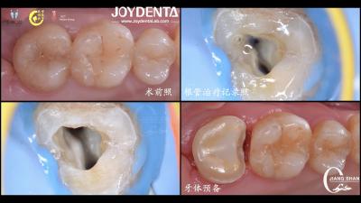 China Long Lasting Natural Looking dental ceramic inlay Precise Fit High Compatibility for sale