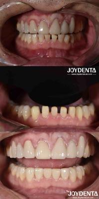 China Nature Shape Cosmetic Dentistry Porcelain Veneers , Dental Cosmetic Porcelain Veneers for sale