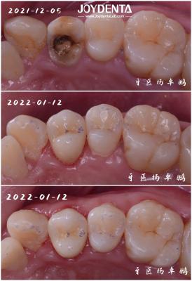 China Genaue Zahnporzellan-Einlage zur Wiederherstellung beschädigter Zähne für Erwachsene und Kinder zu verkaufen