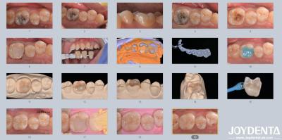 Chine Adultes Enfants Porcelaine en céramique en incrustation dentaire pour les dents endommagées à vendre