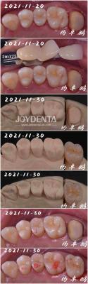 Chine Procédure dentaire en porcelaine en incrustation sans couture Forme personnalisable pour la réparation des dents à vendre