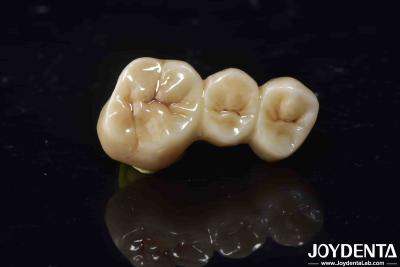 China High Biocompatibility Zirconia Full Contour Crown Perfect Fit High Strength for sale