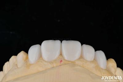 China Materiais de porcelana de personalização Emax Veneers de dentes para ligação de alta estética à venda