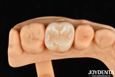 China High Wear Resistance Dental Full Zirconia High Strength Full Contour Zirconia Bridge for sale