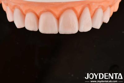 China Fabricação sob medida IPS Porcelana Emax Veneers Restaurações dentárias Resistente a chipping à venda