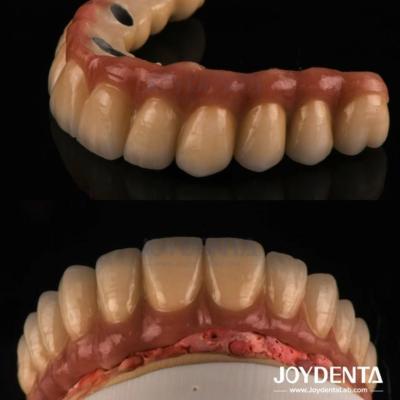 Cina Fusione e fresatura PFM Corona dentale, Restaurazioni dentali Corona metallica fusa in porcellana in vendita