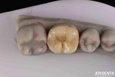 China Customizable Zirconia Inlay Onlay Minimal Preparation For Damaged Teeth Restoration for sale