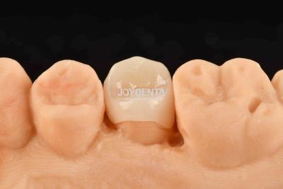 China Customizable White Composite Inlay Onlay Natural Looking Minimally Invasive Tooth Restoration for sale