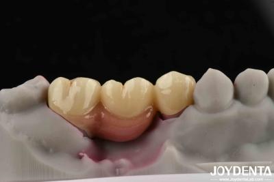 Cina Impianto dentale personalizzabile con ponte e corona per impianti dentali in vendita