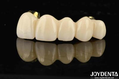 Cina Ponte ibrida in zirconia a ti-bar di eccellente resistenza per la compatibilità di denti e gengive naturali in vendita