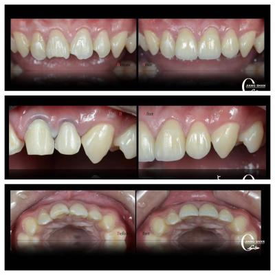 China Nature Dental Veneers For  Natural And Beautiful Smile for sale
