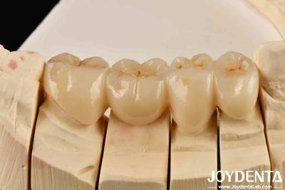 China Unleash Aesthetics Of High Aesthetics Full Zirconia With White And Resistance To Thermal Shock High for sale