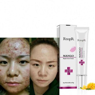 China Professional Acne Cream Acne Treatment Anti Acne Cream Acne Treatment Supplier Herbal Cream for sale