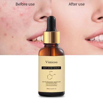 China Wholesale Acne Essence Serum Private Label Tea Tree Tea Tree Salicylic Acid Acne Remover Organic Herbal Face Treatment Acne Essence Serum for sale